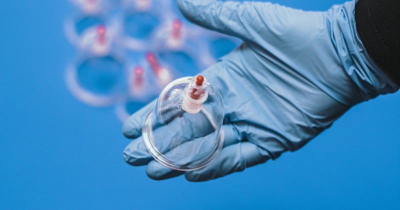 Hijama à Dijon